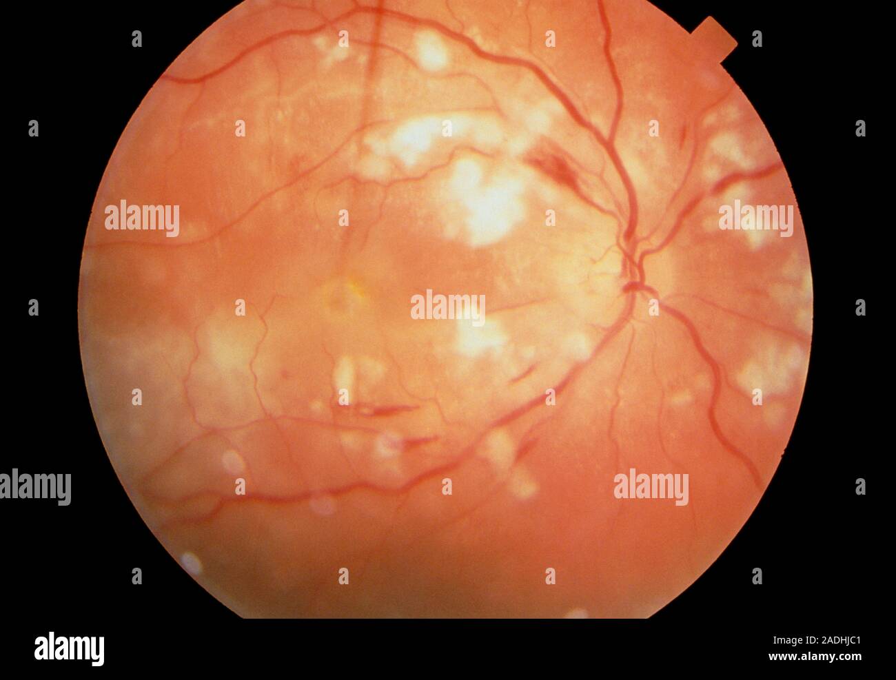 Systemic lupus erythematosus. Ophthalmoscope view of the retina of a