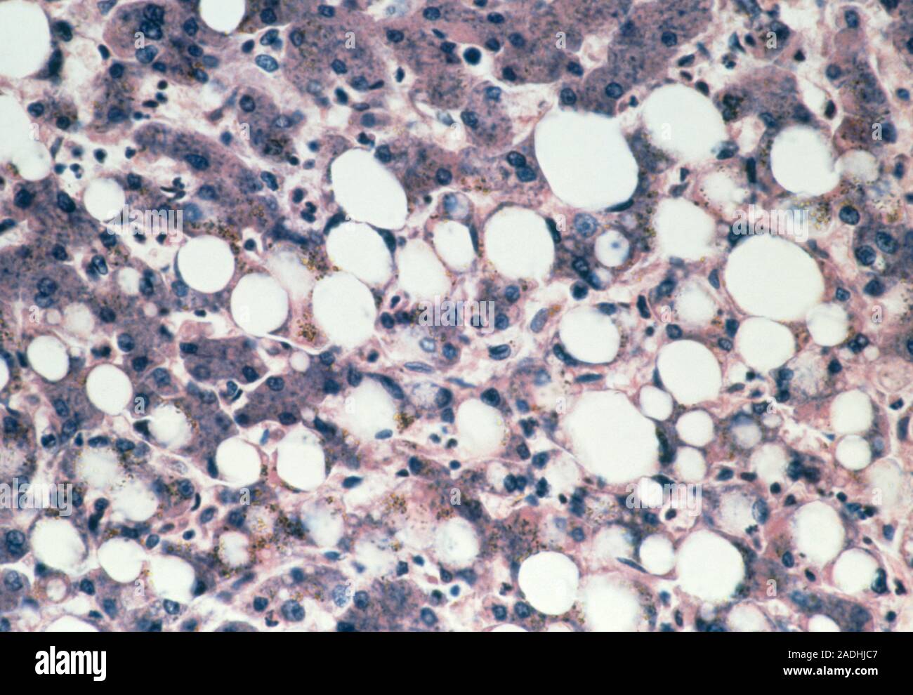 Fatty liver. Light micrograph of a section through the liver of an