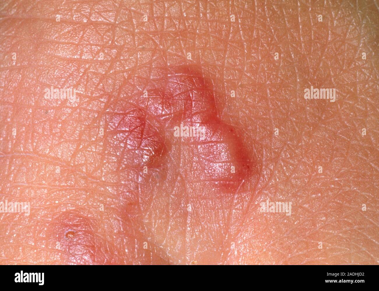 Parasite under skin. Foot of a 33 year old woman showing a cutaneous