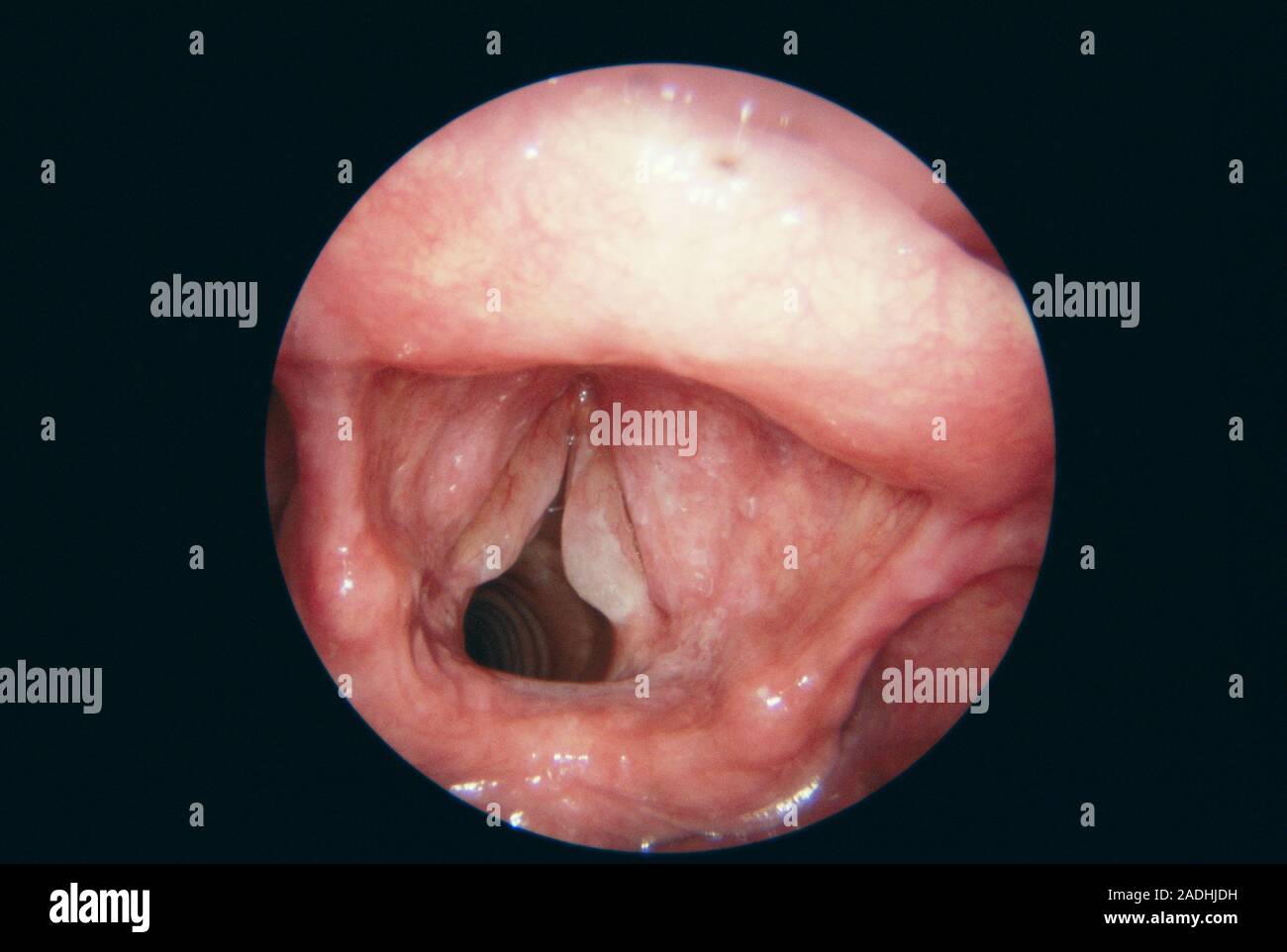 Laryngitis. Endoscope view of the inflamed larynx (voice box) of a