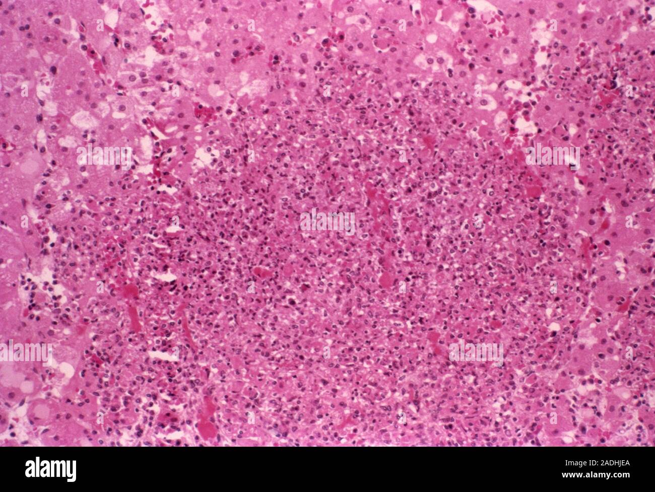 Listeriosis. Light micrograph of a section through liver tissue in a