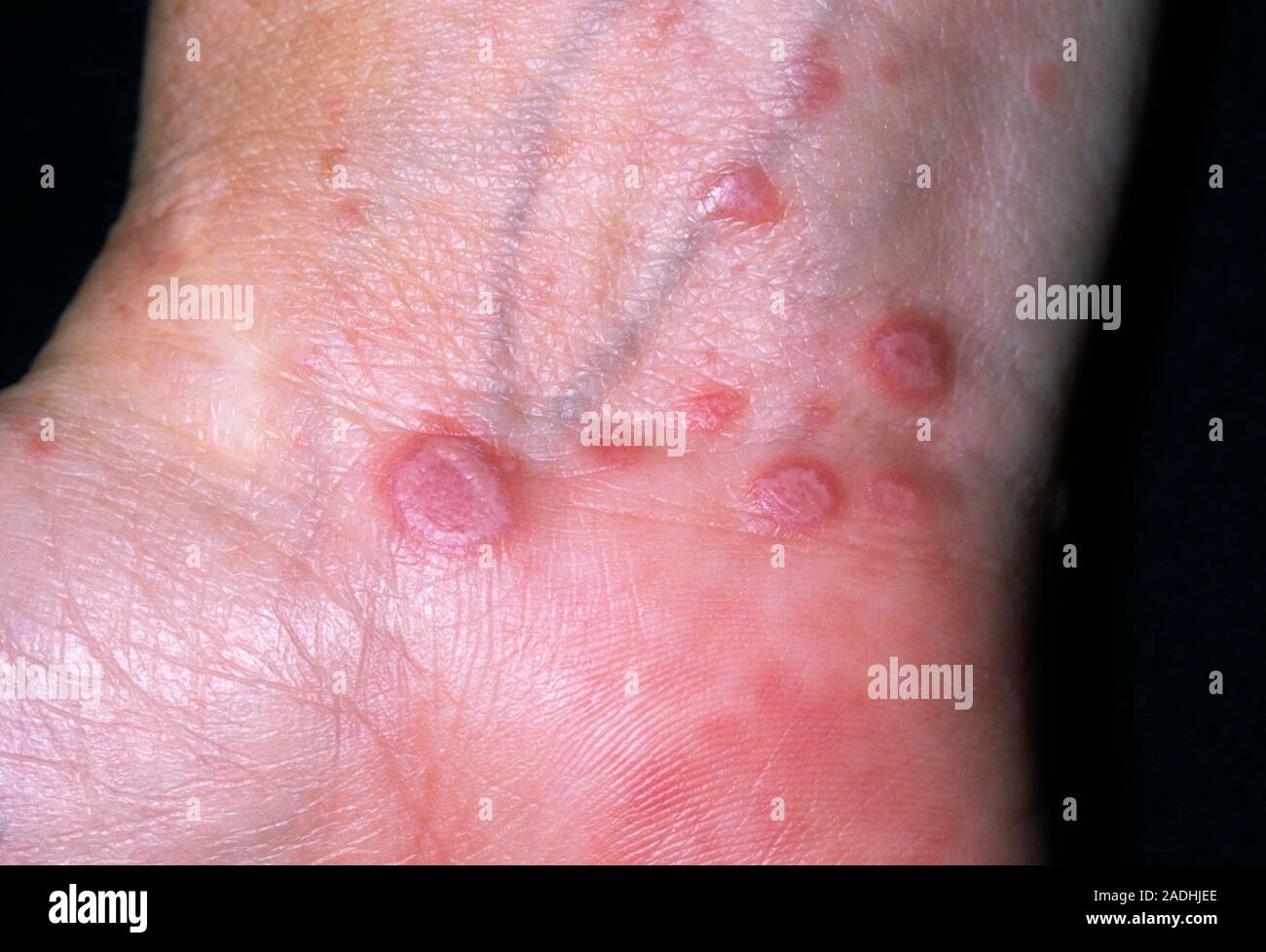 Lichen planus skin disease. Lesions on the inside of the wrist of a 48-year-old female patient, caused by lichen planus. Lichen planus is a chronic sk Stock Photo