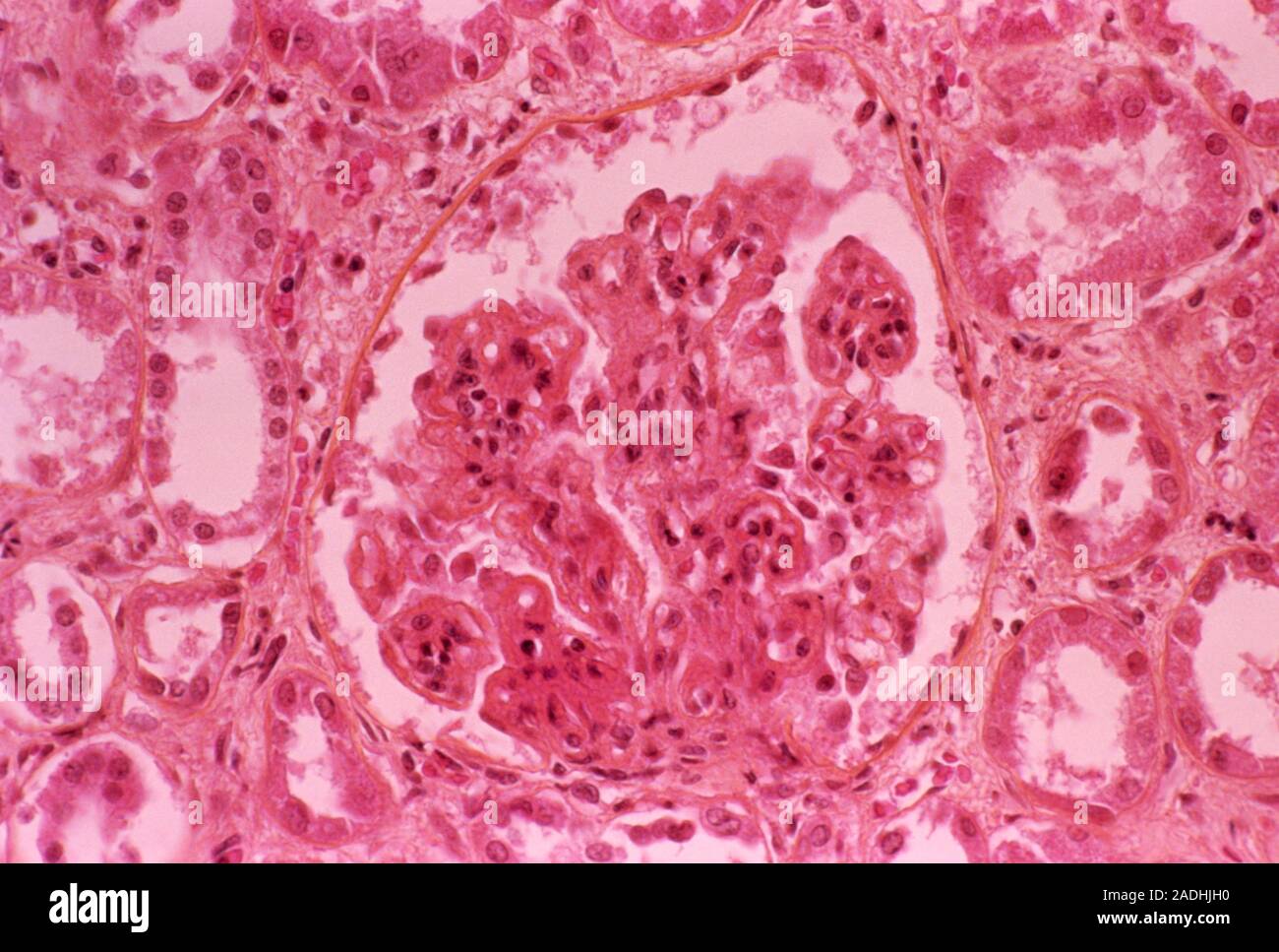 Kidney filtration damaged by immune system. Light micrograph of a
