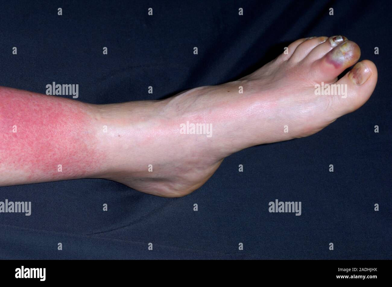 Lymphangitis Infection Of The Leg And Foot Of A 54 Year Old Woman Lymphangitis Is A Bacterial 