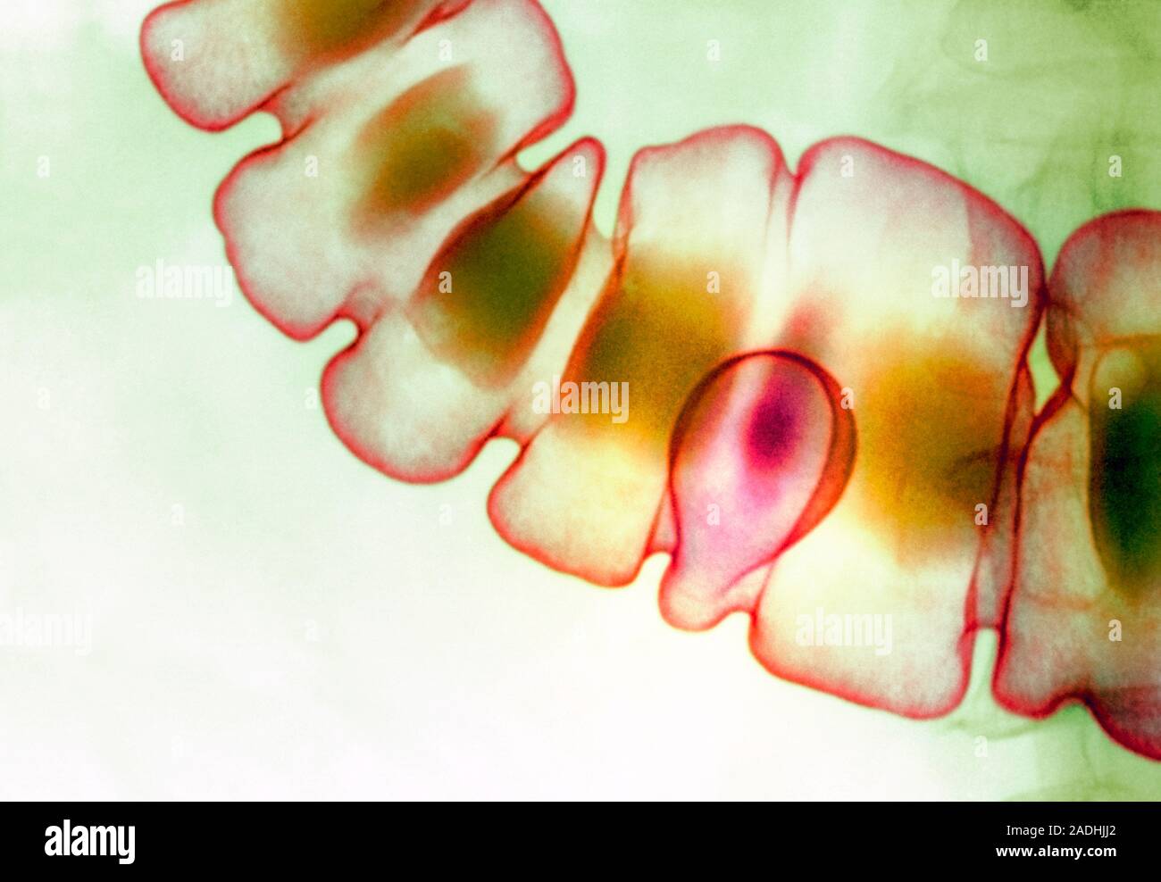 Lipoma in the colon. Coloured X-ray of a lipoma (bulbous shape, lower ...