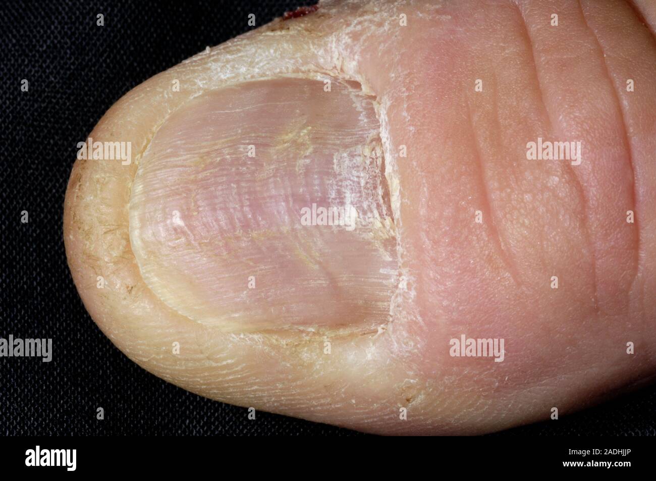 Model Released Thumbnail With Lichen Planus Disease Close Up Of The Thumb Of A 55 Year Old Man Model Released Thumbnail With Lichen Planus Disease Close Up Of The Thumb Of A 55 Year Old Man
