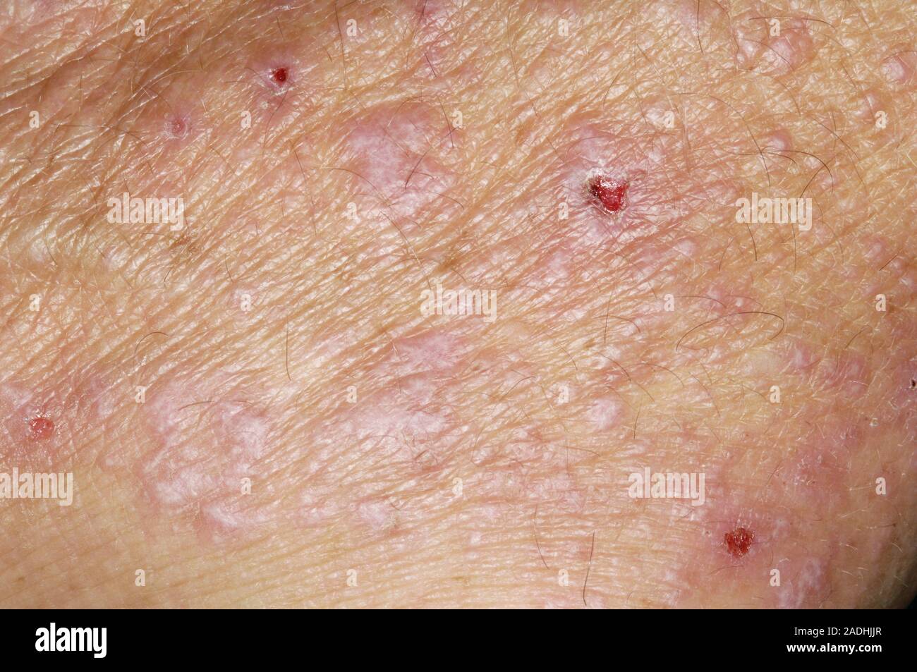 Model Released Lichen Planus Disease Close Up Of The Skin Of A 55 Year Old Man With Lichen Model Released Lichen Planus Disease Close Up Of The Skin Of A 55 Year Old Man With Lichen