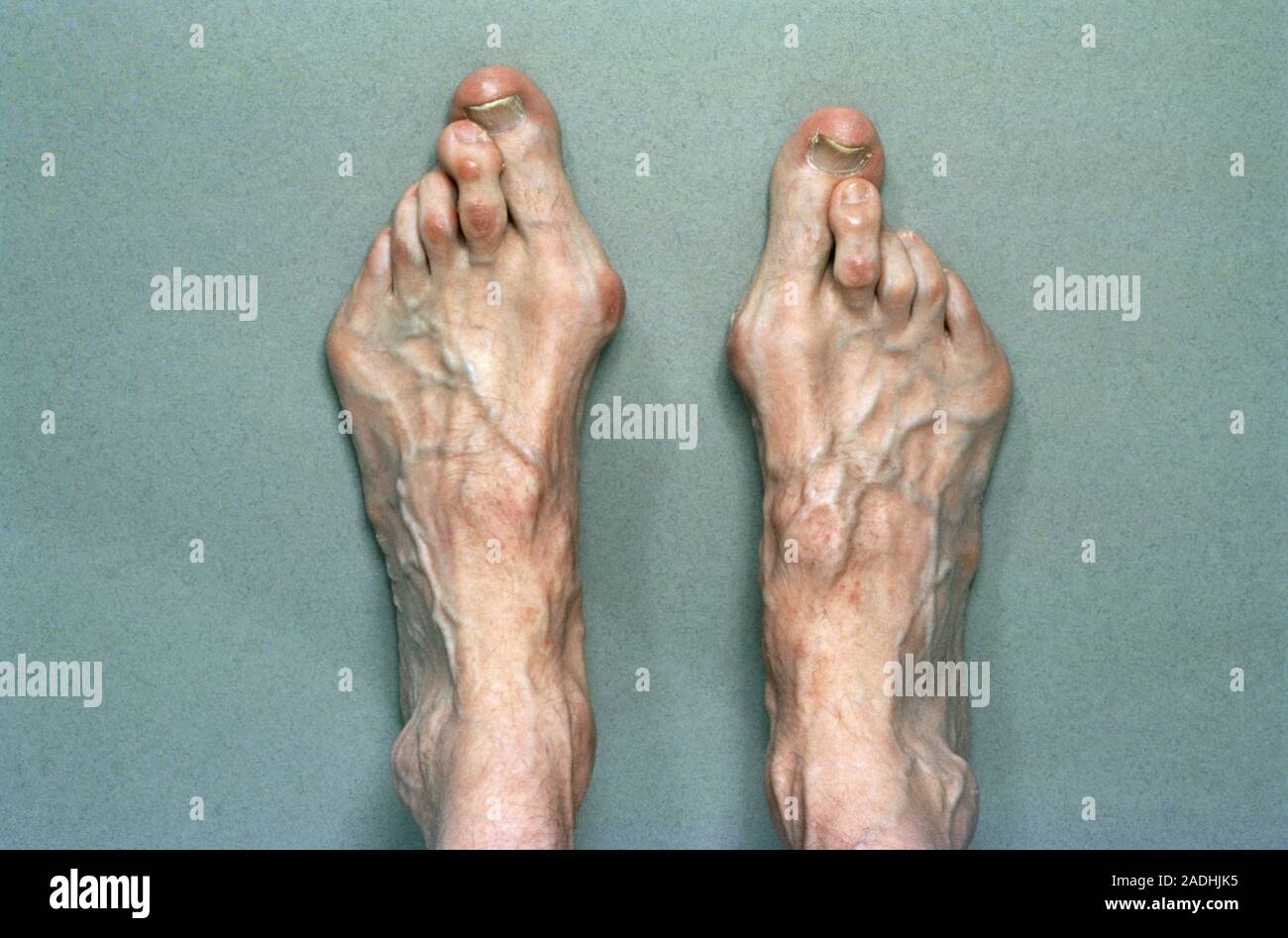Photograph of the feet of a person suffering from Marfan's syndrome, showing abnormally elongated & slender toes. Marfan's syndrome is an inherited di Stock Photo