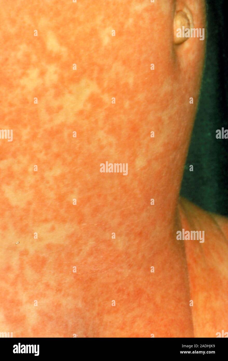 Infant girl covered with measles rash. Measles (medical names rubeola