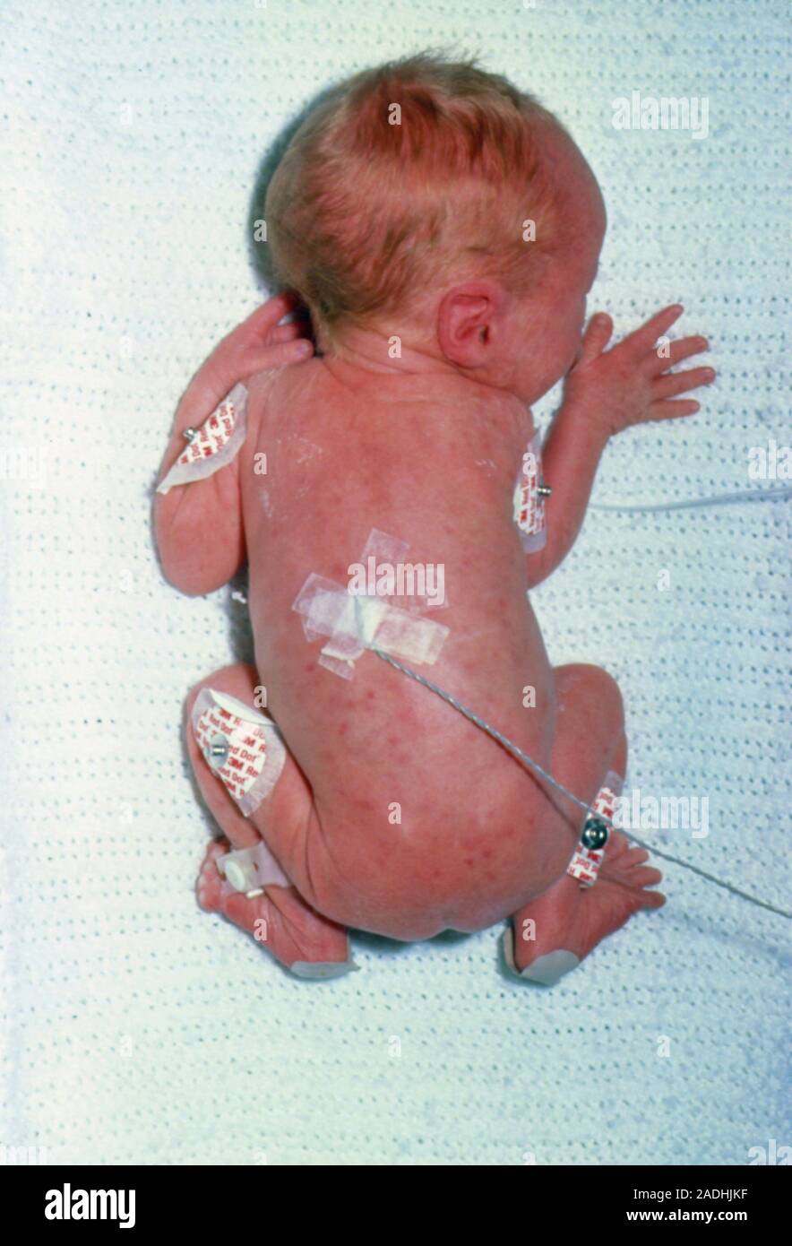 New-born infant suffering from congenital rubella syndrome (german measles  Stock Photo - Alamy