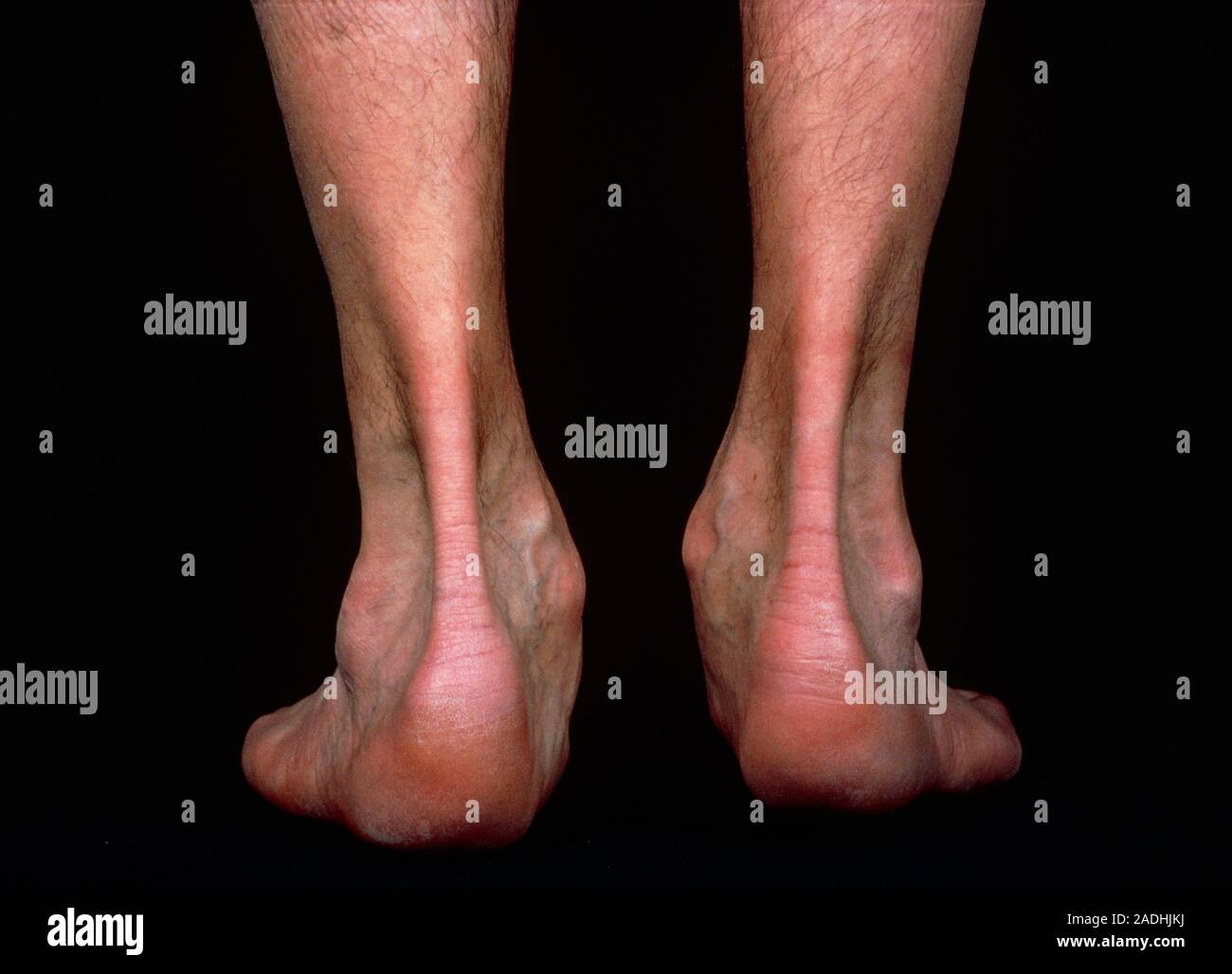 Neurological atrophy of muscles of the ankles. This may occur following