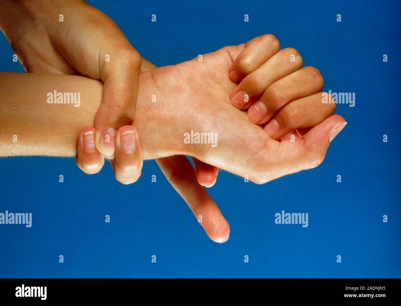Marfan's syndrome. Hands of a young woman with Marfan's syndrome