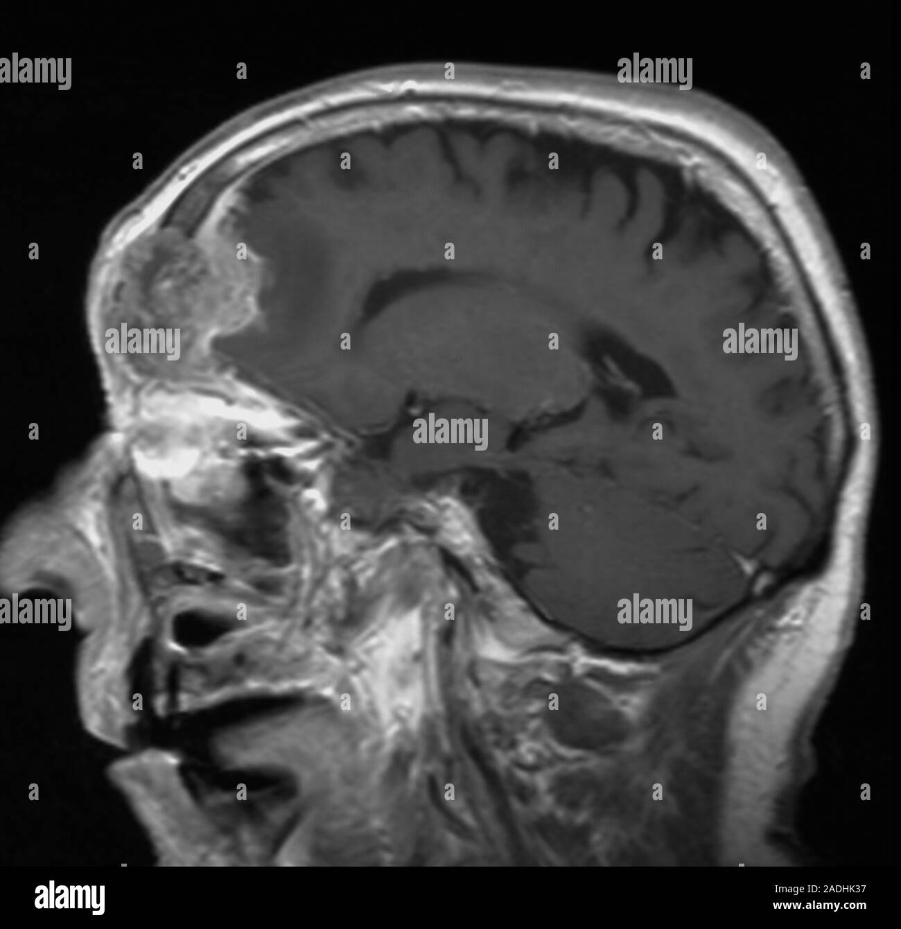 Mucocele growth. Magnetic resonance imaging (MRI) scan of a sagittal ...