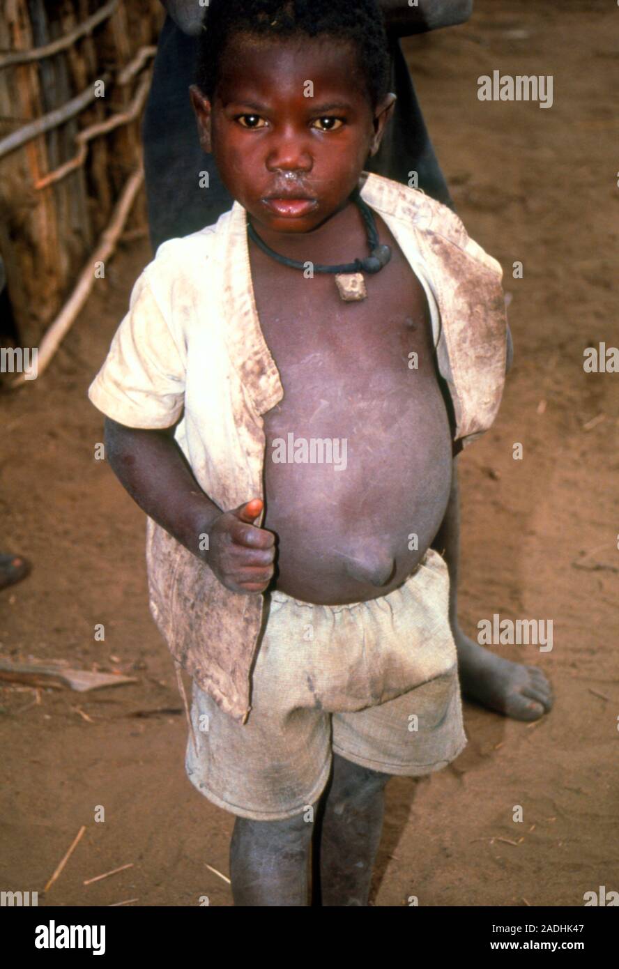 Malnourished boy. View of a malnourished young boy. His swollen abdomen