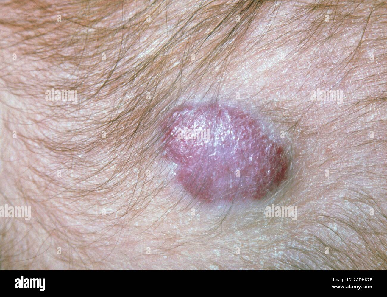 Strawberry naevus, a form of birthmark, a benign collection of small