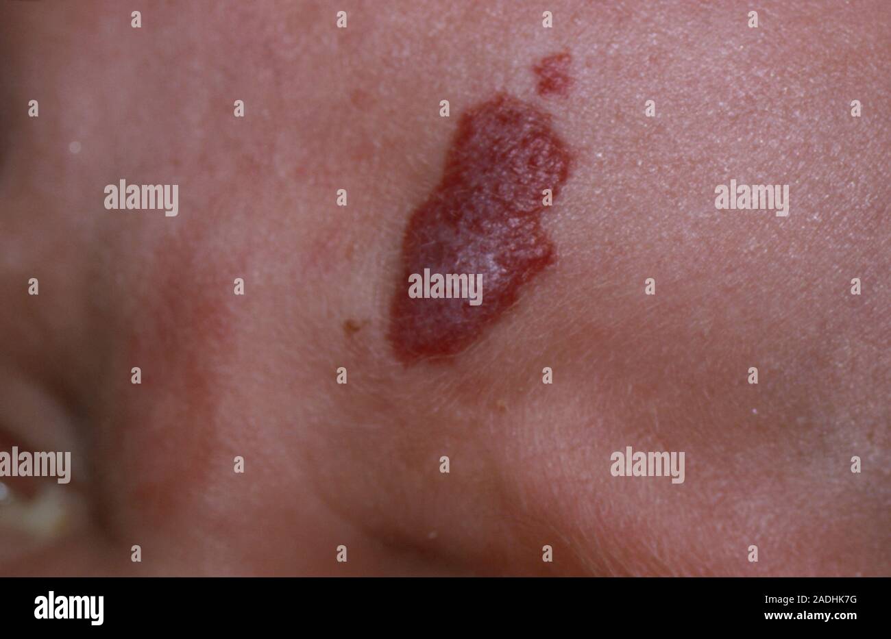 A vascular naevus, also known as a strawberry mark, on the forehead of