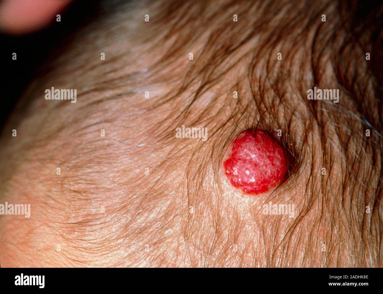 Strawberry mark. A strawberry mark on a baby's head. The bright red