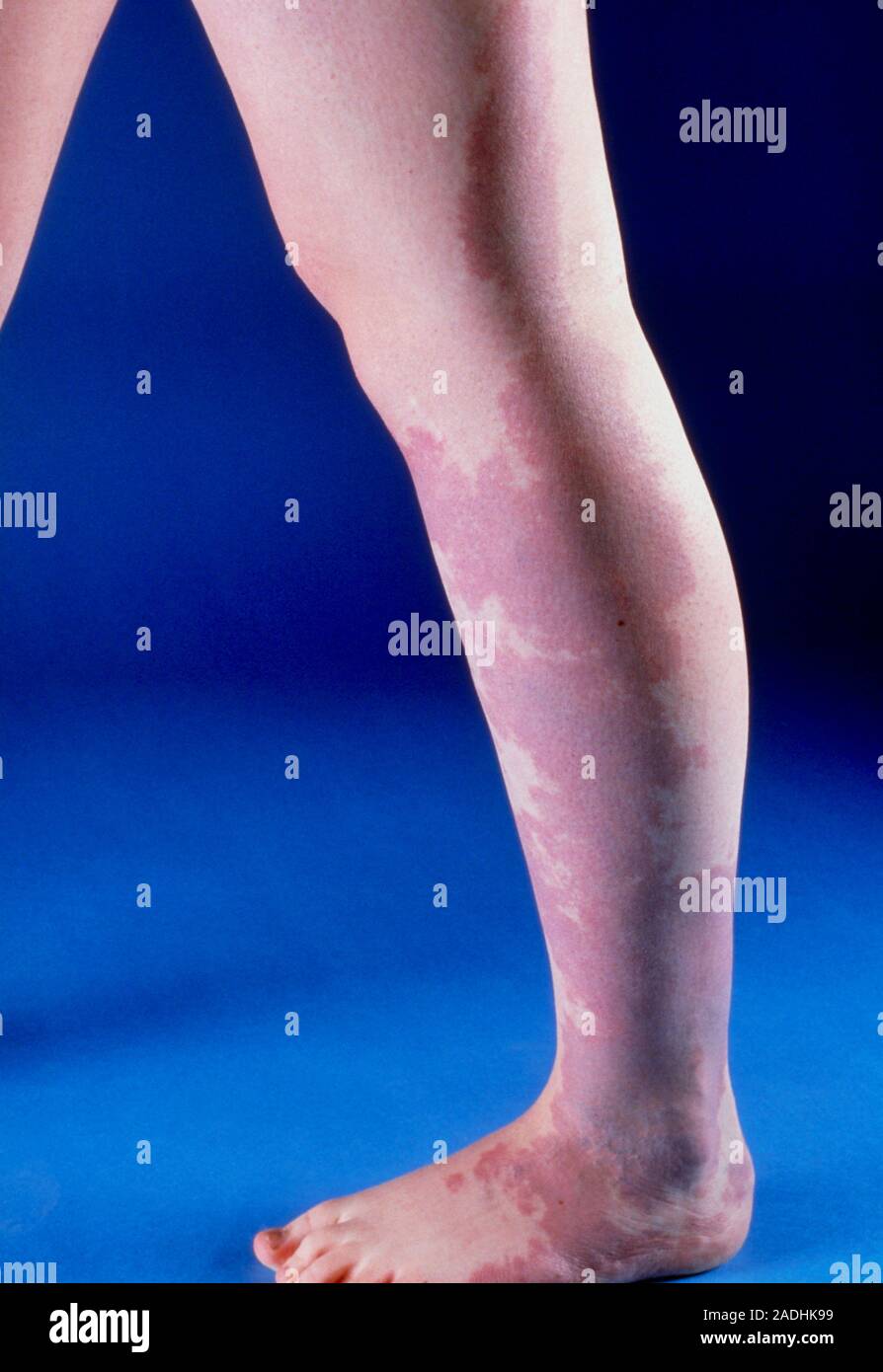 Portwine stain. View of the leg of a child showing an extensive port