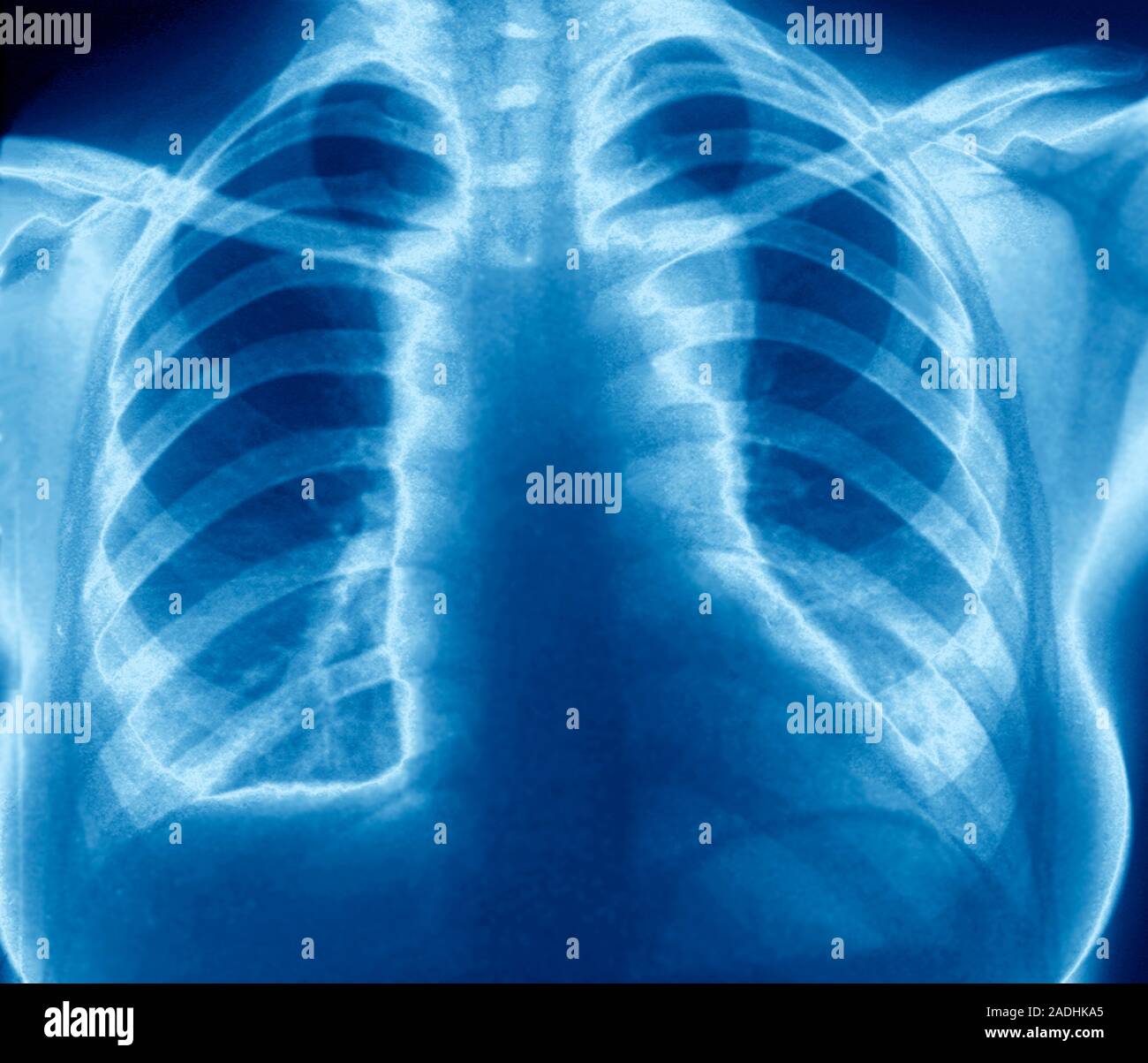 Neurofibromatosis. Coloured frontal chest Xray of a patient with the