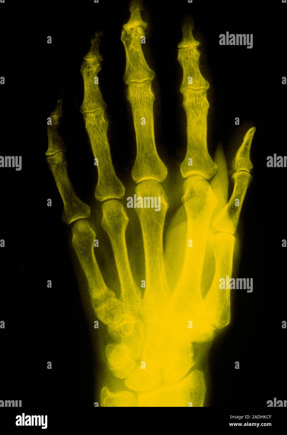 Falsecolour Xray image of a hand showing osteomalacia, a softening of