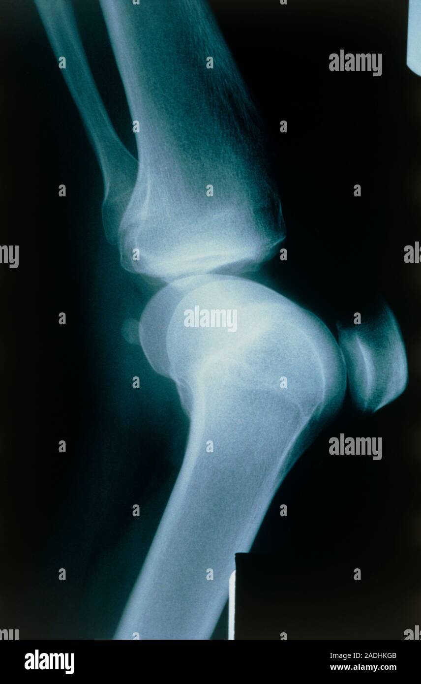 Osteochondritis dissecans. X-ray of a human knee with the joint disease ...