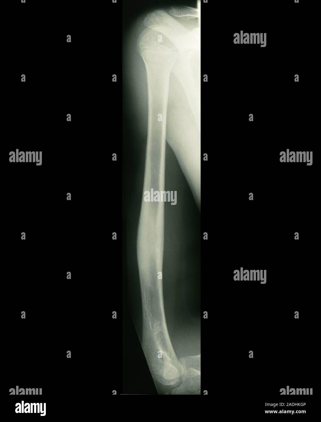 Osteoid osteoma. X-ray of an osteoid osteoma (lower centre) in the ...