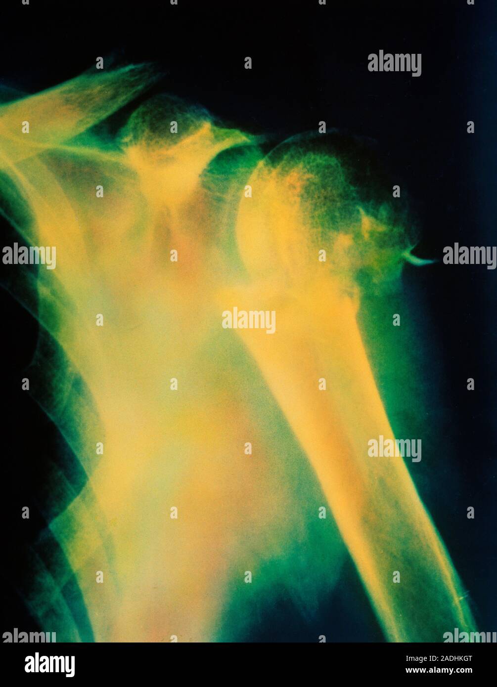 Fracture in osteoporosis. Coloured Xray of a fractured humerus (upper