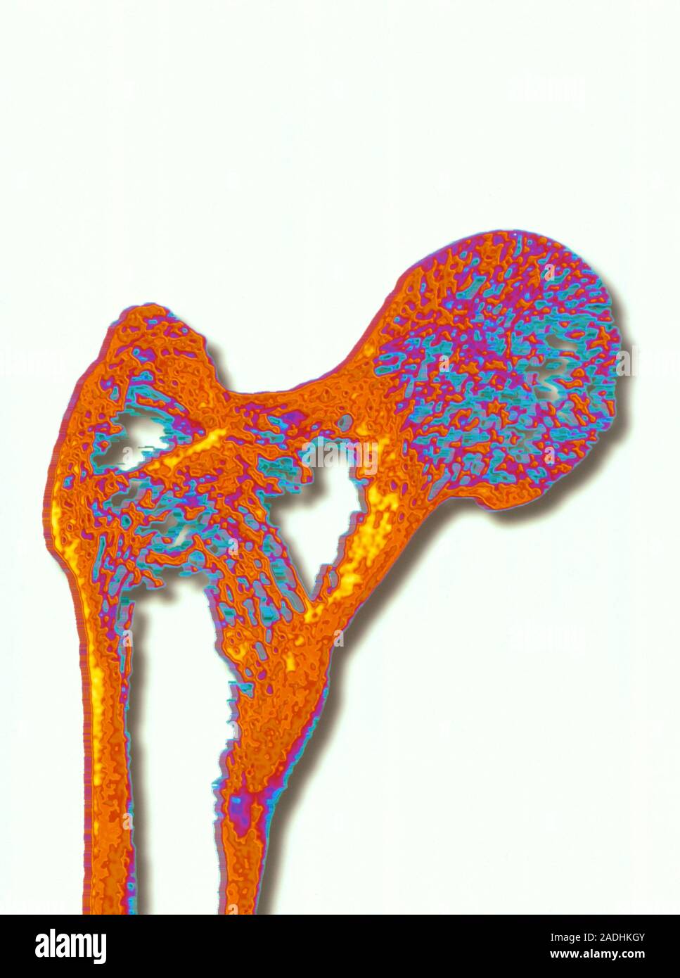Osteoporosis. Coloured Xray of the head of a femur thigh bone diseased