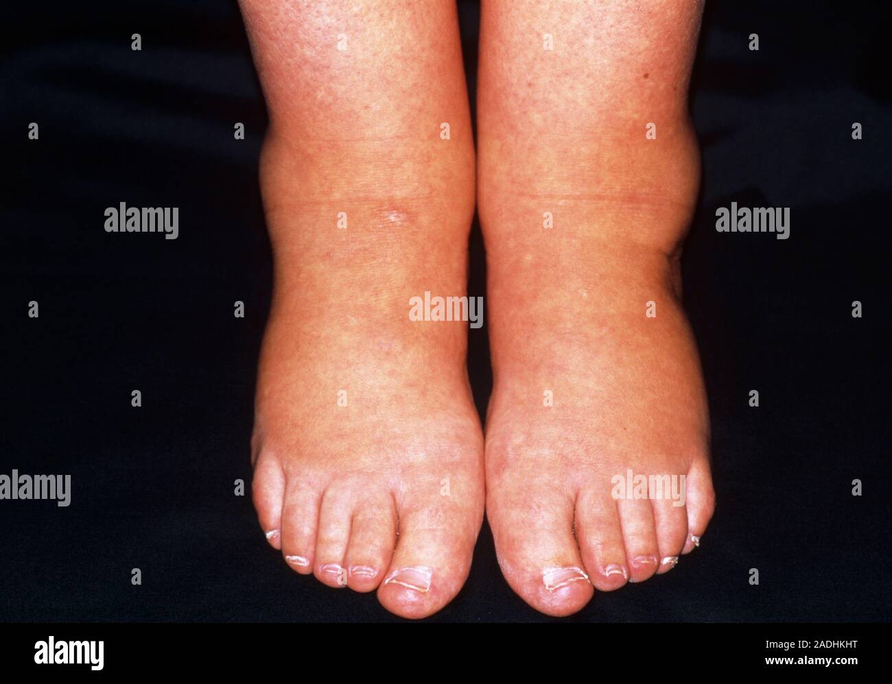 Oedema. Swollen feet and ankles of a woman suffering from oedema