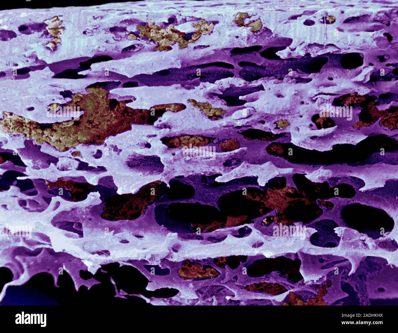 Osteoporosis. Coloured scanning electron micrograph (SEM) of a bone