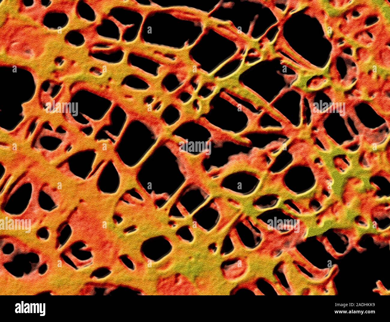 Osteoporosis. Coloured scanning electron micrograph (SEM) of the bone of a person suffering from