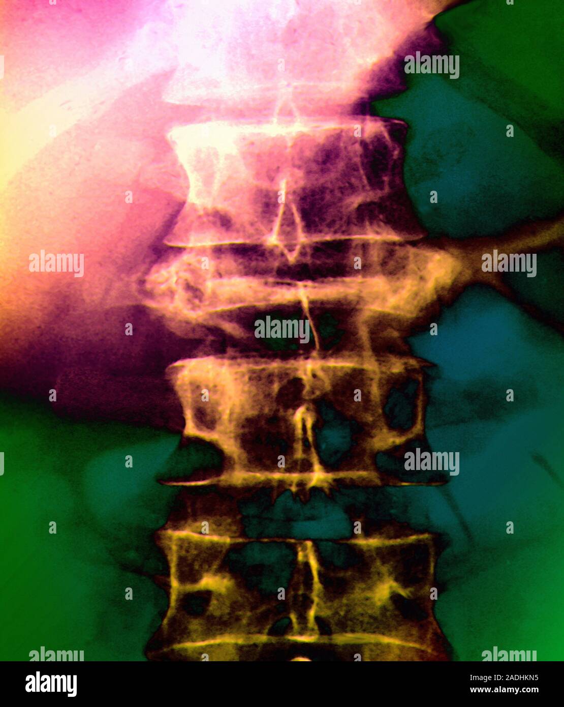 Osteoporosis of spine. Coloured Xray of the lower back of a patient
