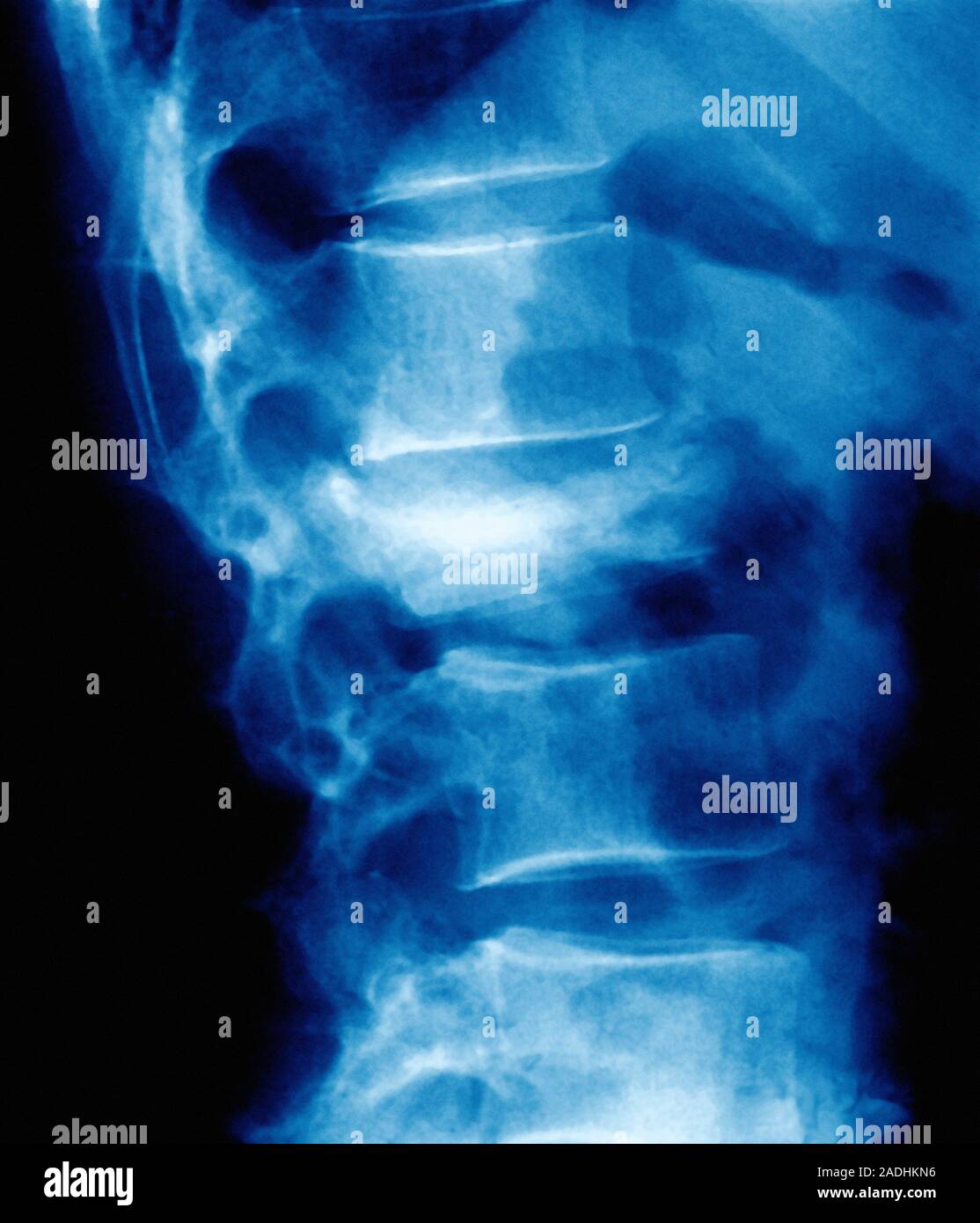 Osteoporosis of spine. Coloured Xray of the lower back of a patient