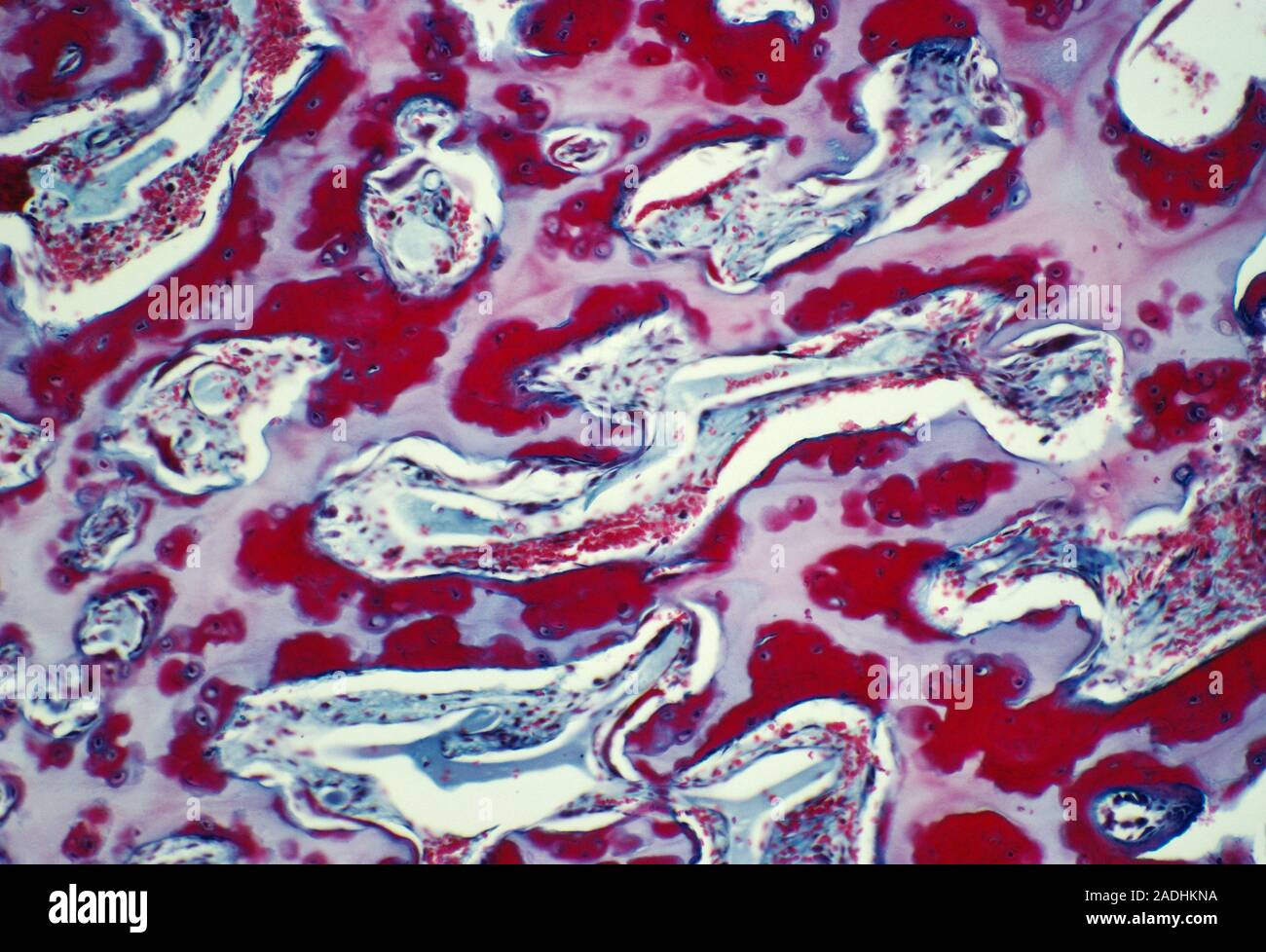 Osteoporotic bone. Light micrograph of a section through bone tissue from a patient suffering