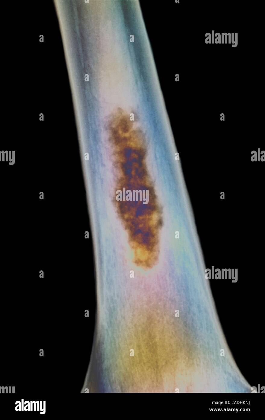 Bone death. Coloured Xray of the shaft of a human long bone showing