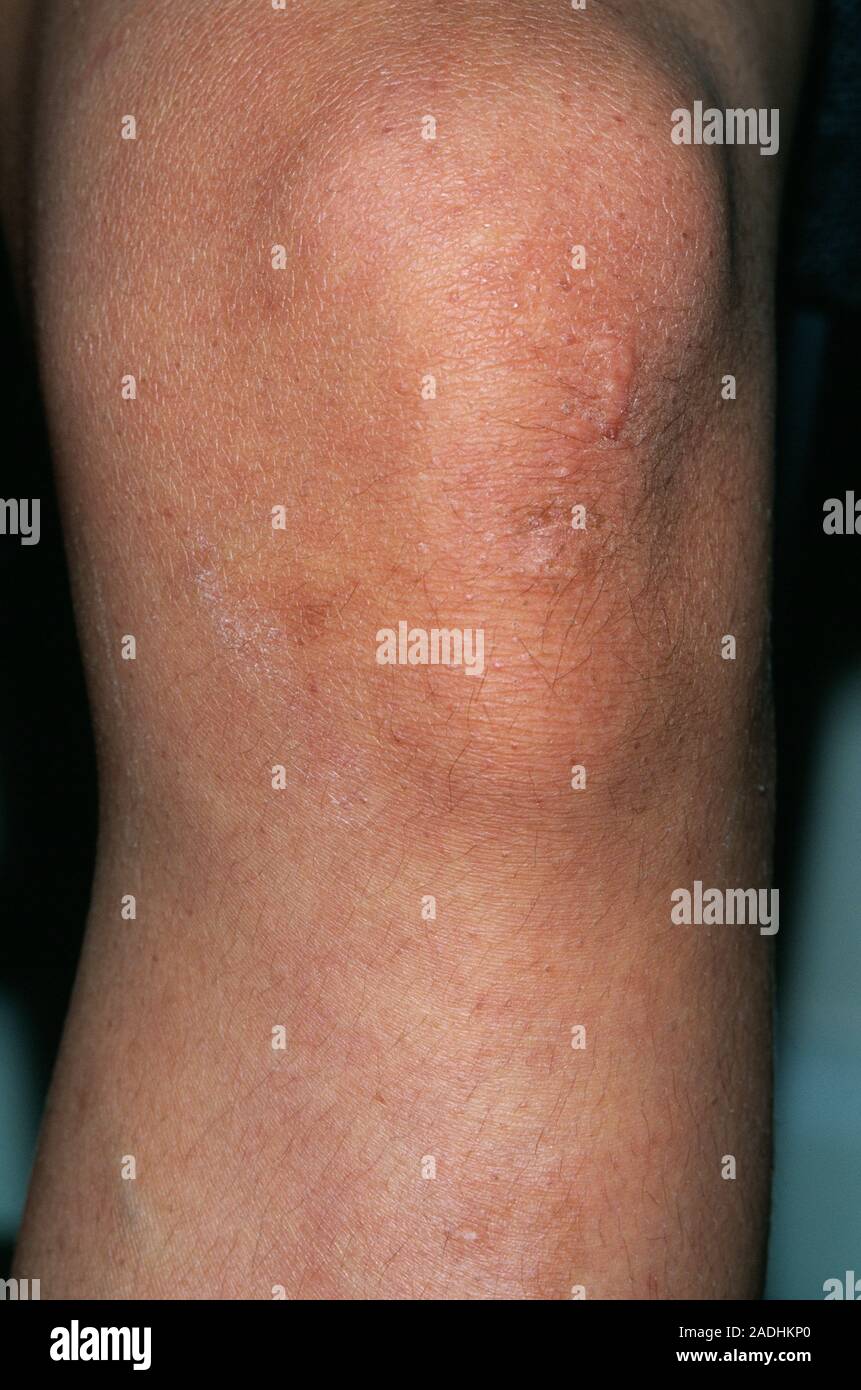 OsgoodSchlatter's disease. Knee of a 13yearold boy with a bony