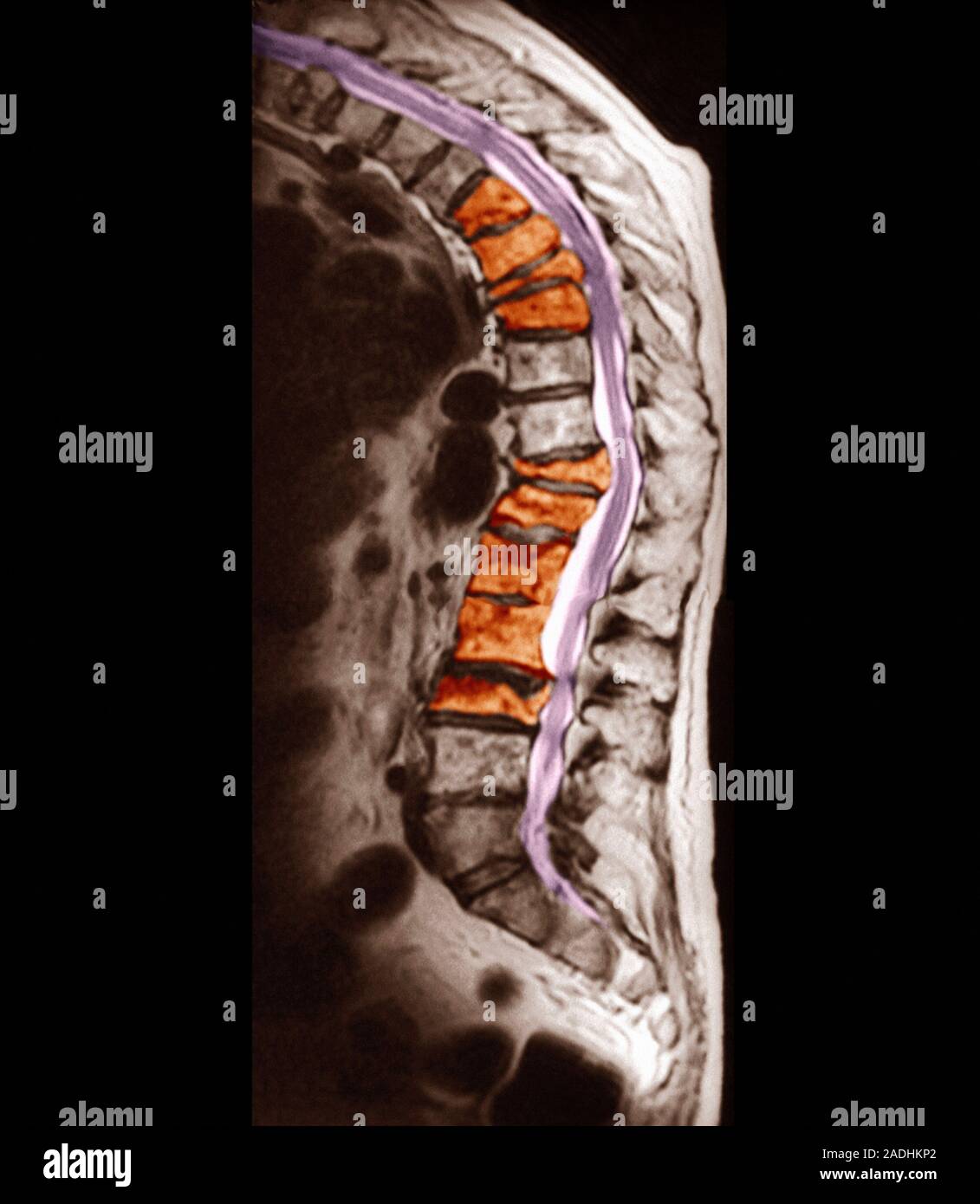 Osteoporosis. Coloured sagittal (side) resonance imaging (MRI