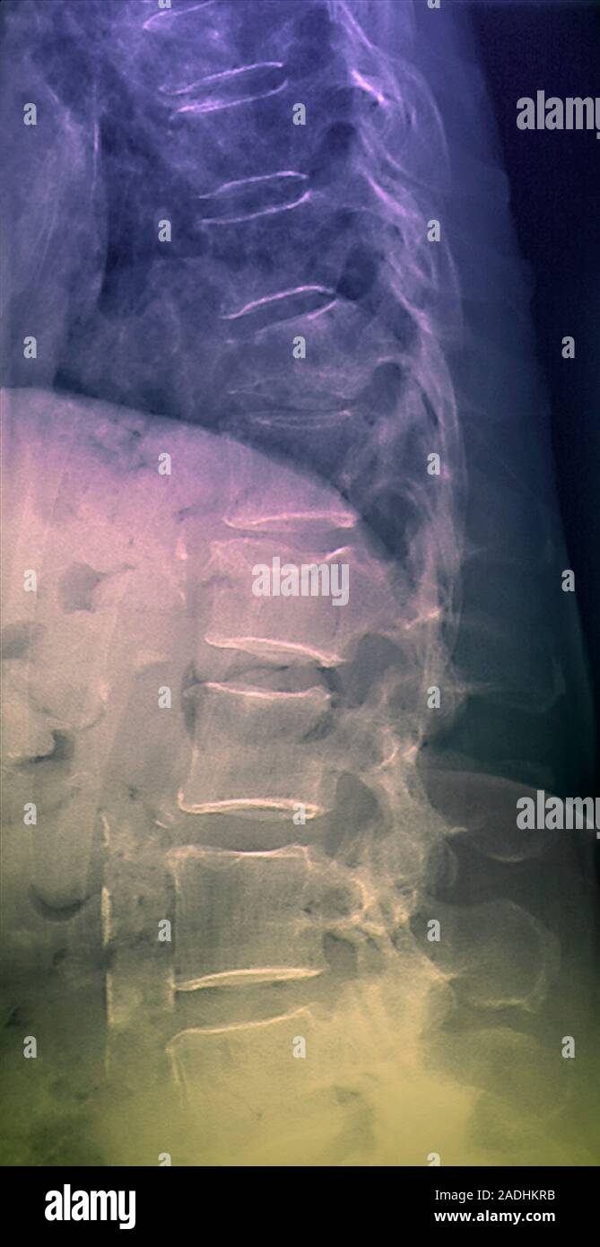 Spinal osteoporosis. Coloured Xray of a side view of the dorsolumbar