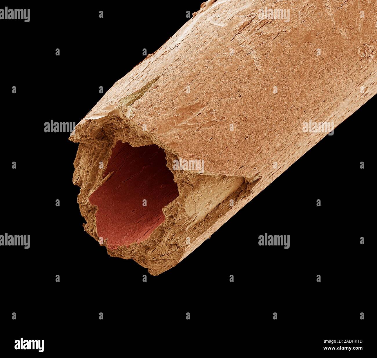 Osteoporotic bone. Coloured scanning electron micrograph (SEM) of a