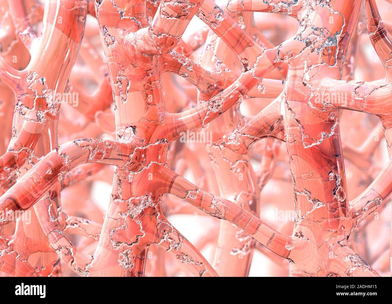 Brittle bone disease. Computer artwork of the bony network (trabeculae
