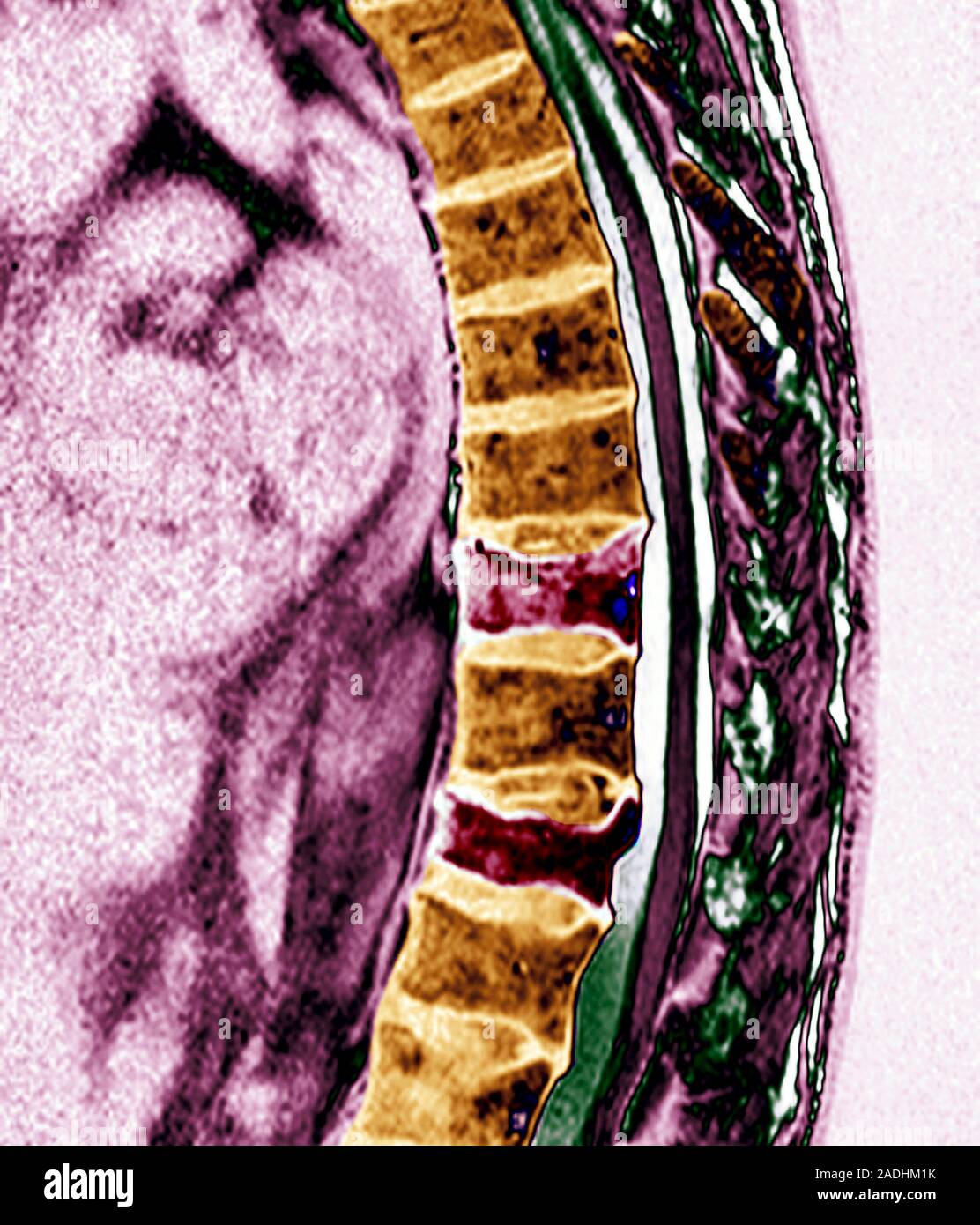 Osteoporosis. Coloured resonance imaging (MRI) scan of a