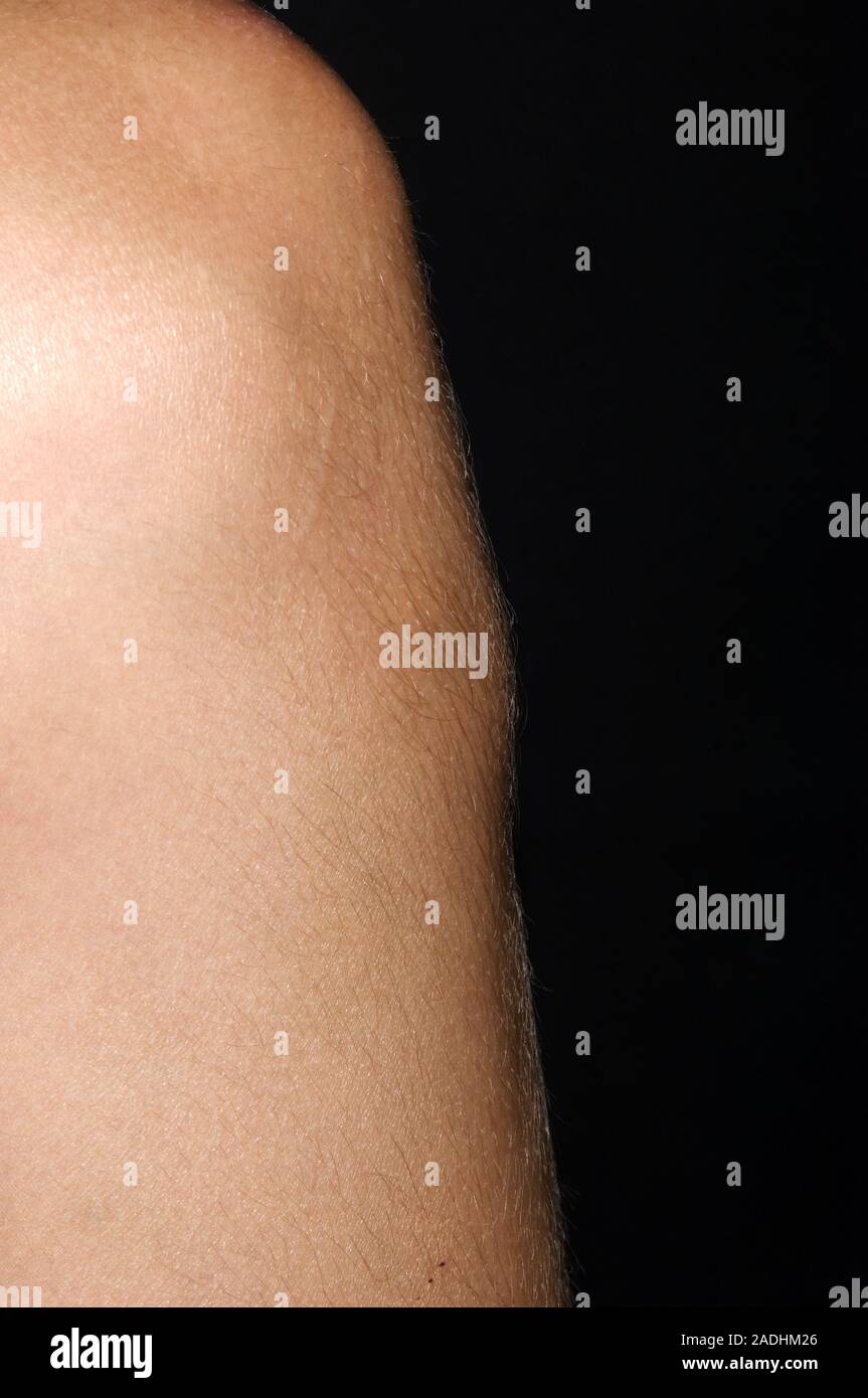 MODEL RELEASED. OsgoodSchlatter disease. Lump beneath a 14 year old boy's patella (kneecap