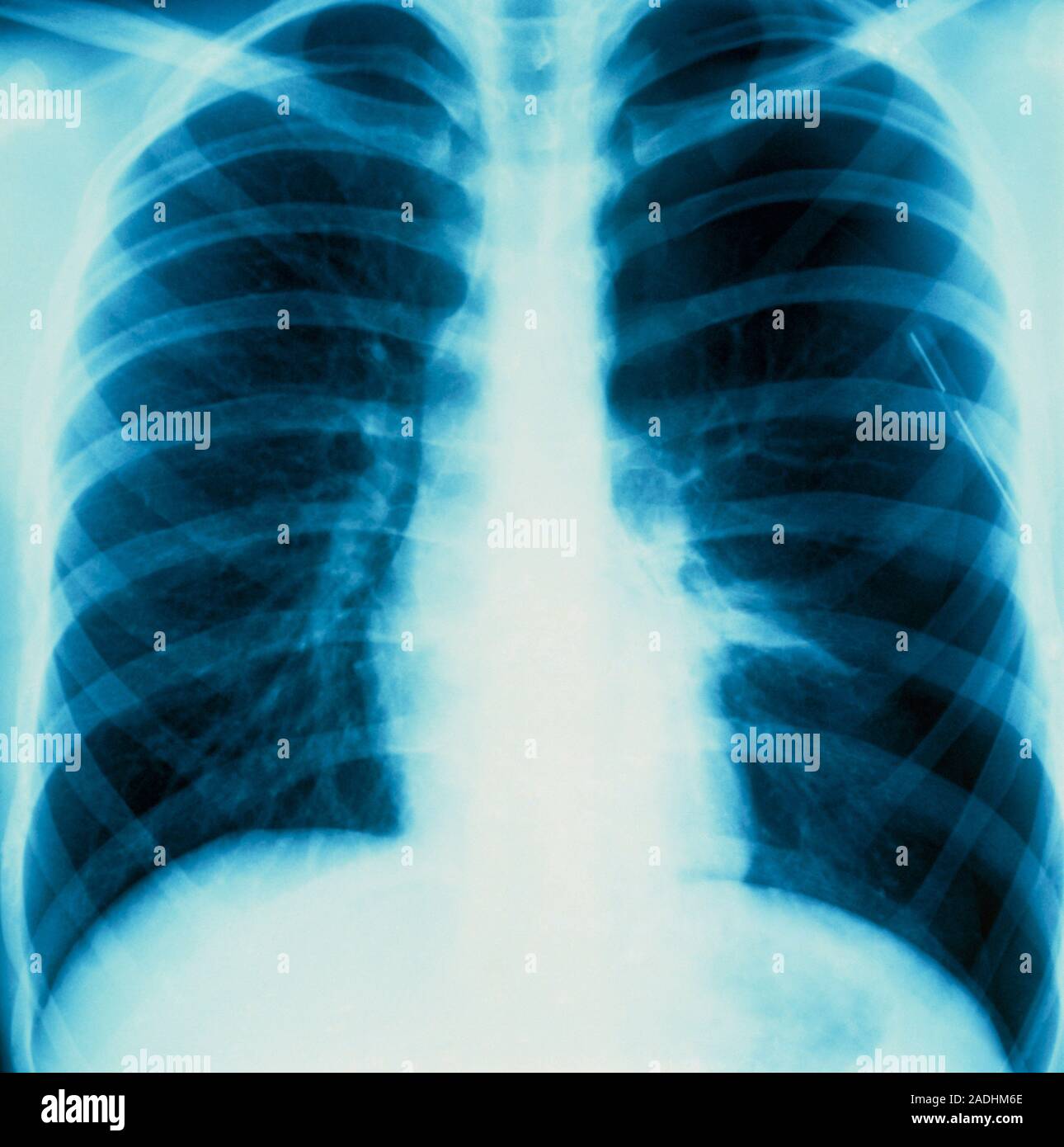 X-ray showing the left lung (right of image) affected by pneumothorax ...