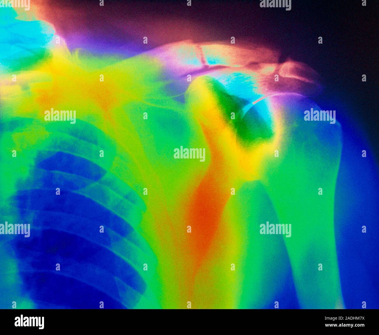 Paget's disease fracture. Coloured Xray showing a fractured clavicle