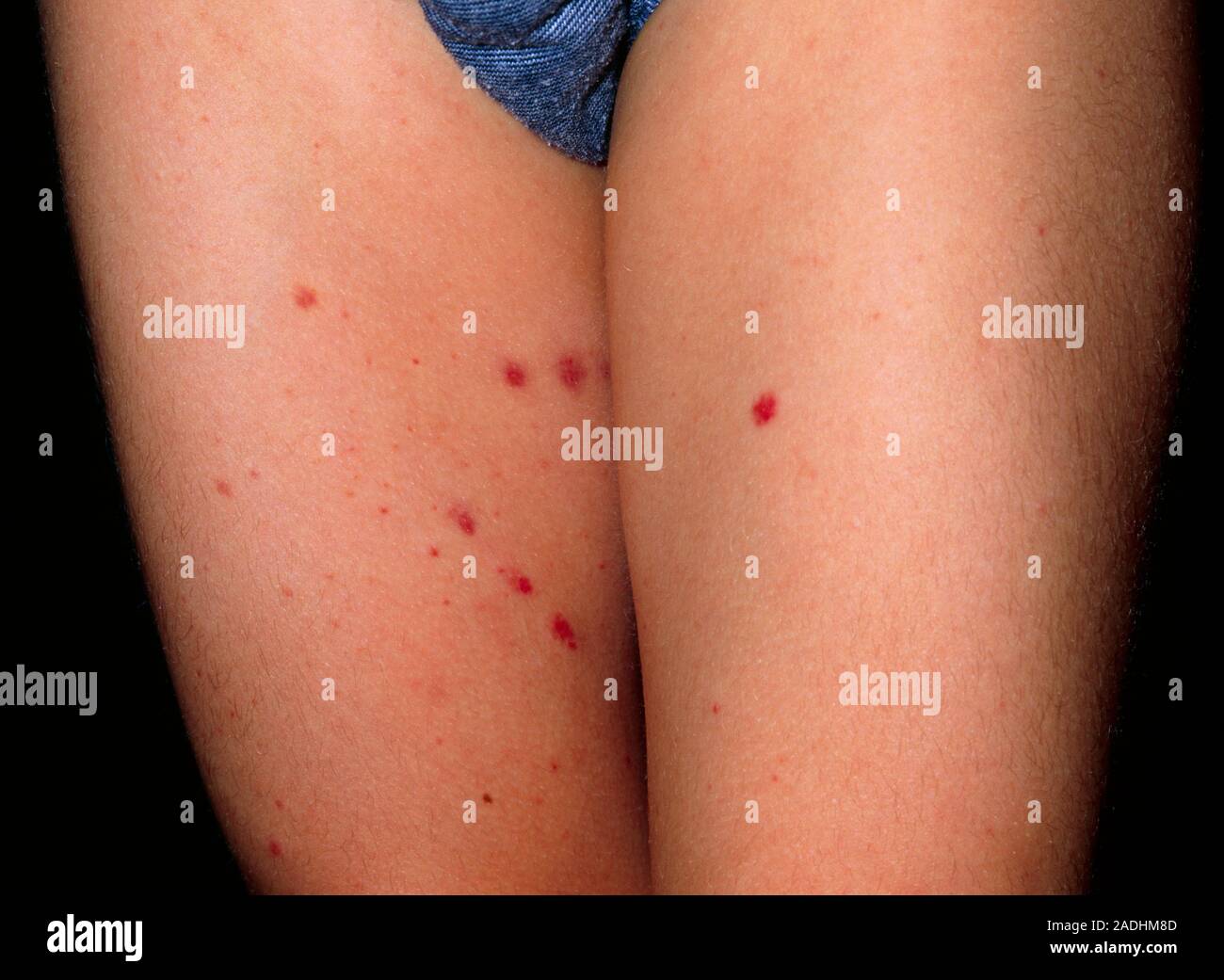 Henoch-Schonlein purpura. Purple rash seen on the thighs of a six year ...