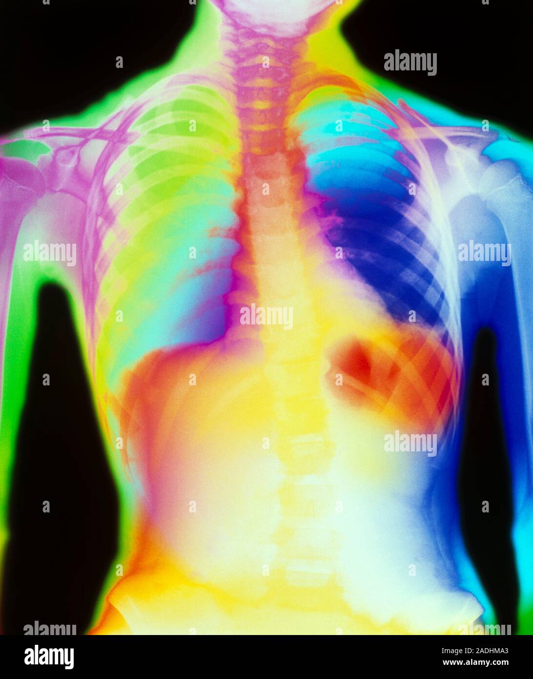 Pneumonia. Coloured chest X-ray of a seven year old girl with pneumonia ...