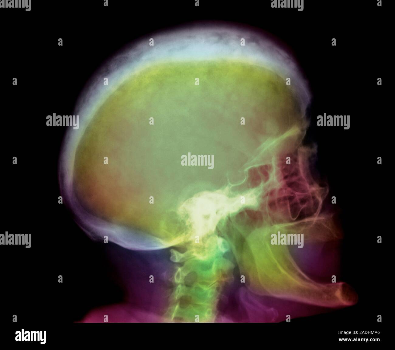Paget's disease. Coloured Xray showing a skull in Paget's disease or