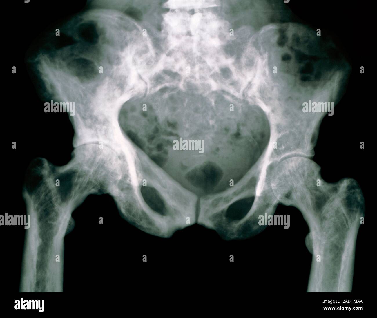 Paget's disease. Xray showing the pelvis of a person suffering from