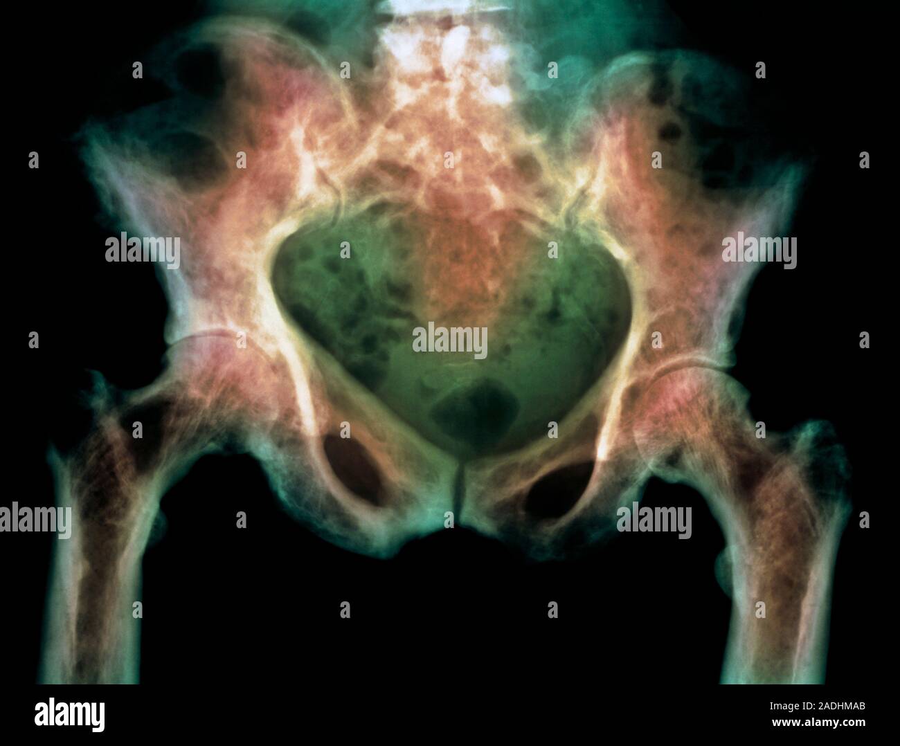 Paget's disease. Coloured Xray showing the pelvis of a person