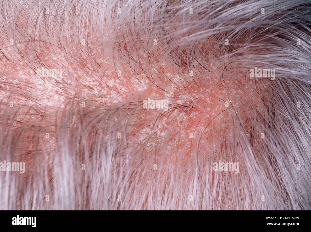 Psoriasis On The Scalp Of A 71-year-old Woman Suffering From Psoriasis 